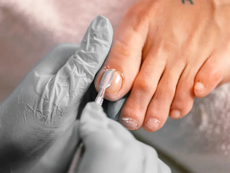 A gloved hand using a small instrument to tidy the edge of a toenail